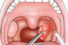 tonsillectomy surgeon specialist